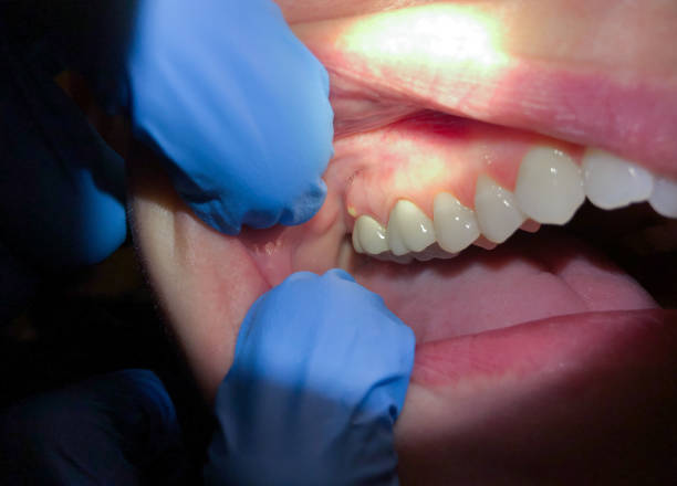 Best Urgent Care for Lost Fillings or Crowns in Avon, MN