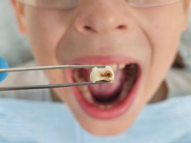 Best Emergency Dental Care for Broken or Chipped Teeth in Avon, MN